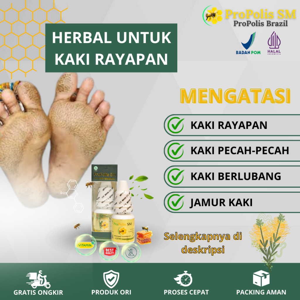 Obat Kaki Rayapan, Obat Kaki Berlubang, Obat Kaki Pecah-Pecah Dengan Propolis SM
