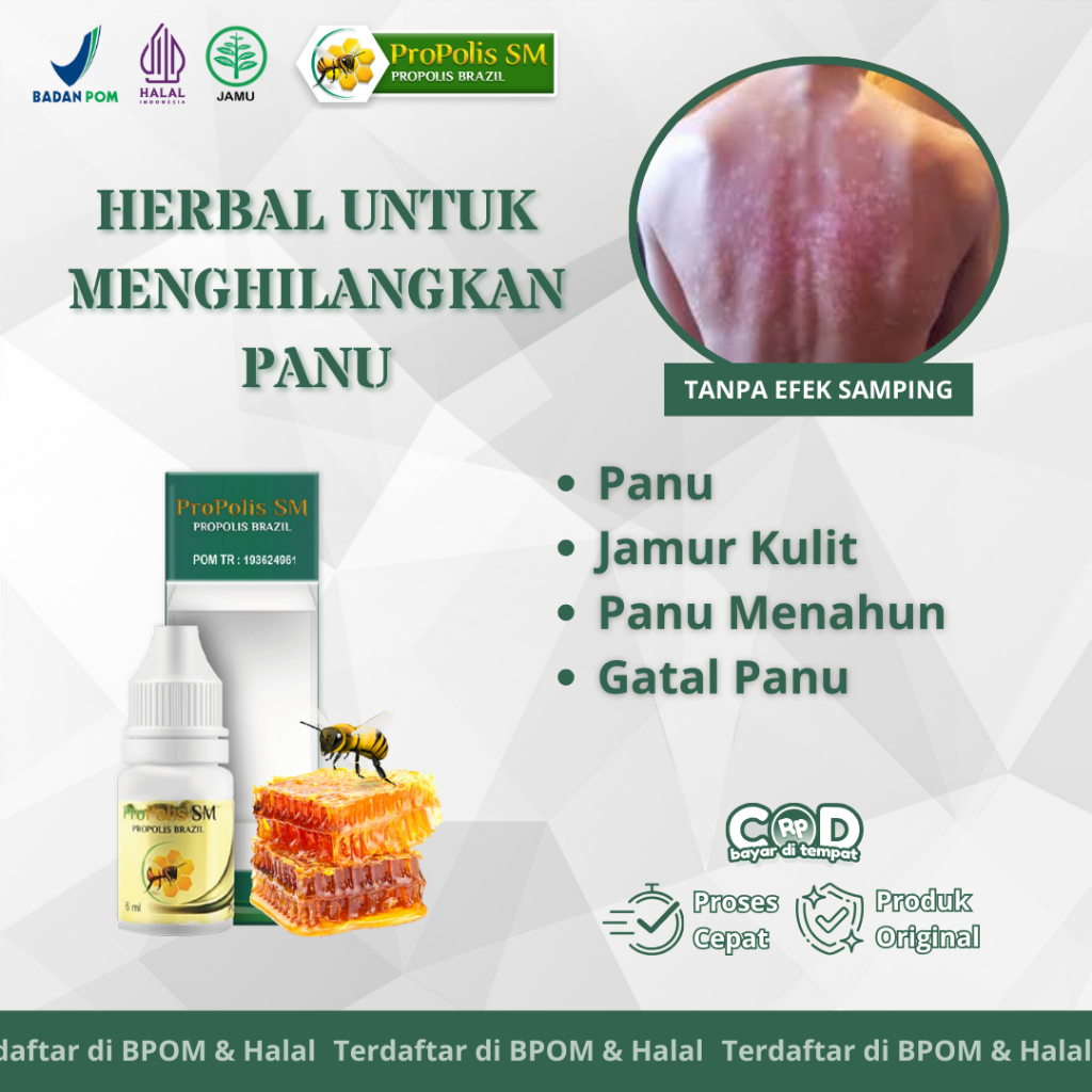 Propolis SM Obat Panu, Penghilang Panu, Obat Panu Cair, Obat Jamur Kulit, Obat Gatal Panu Isi 6 Ml