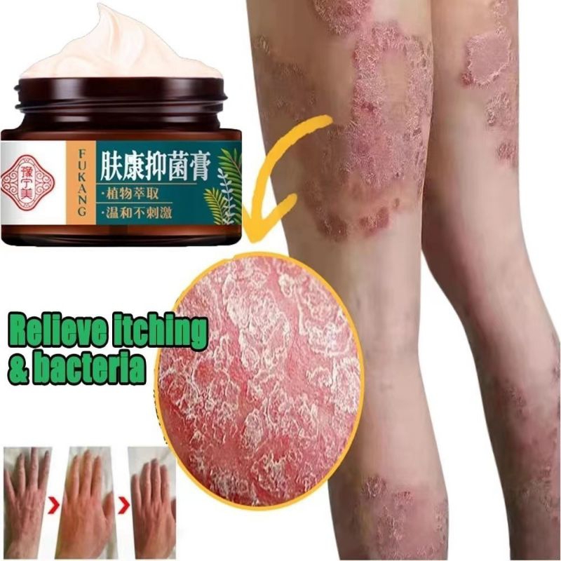 Salep Gatal Paling Ampuh Obat Gatal Paling Ampuh Salep Kulit Gatal Kulit Eksim Gatal Sel... 
