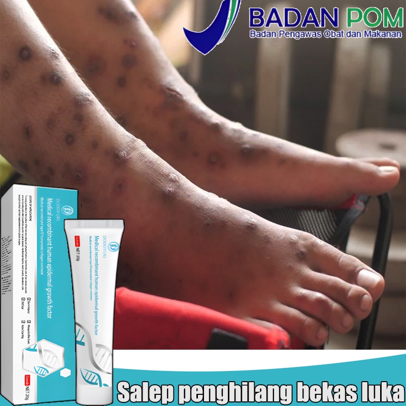 Obat penghilang bekas luka Salep penghilang bekas luka Salep penghilang bekas luka hitam Penghilang 