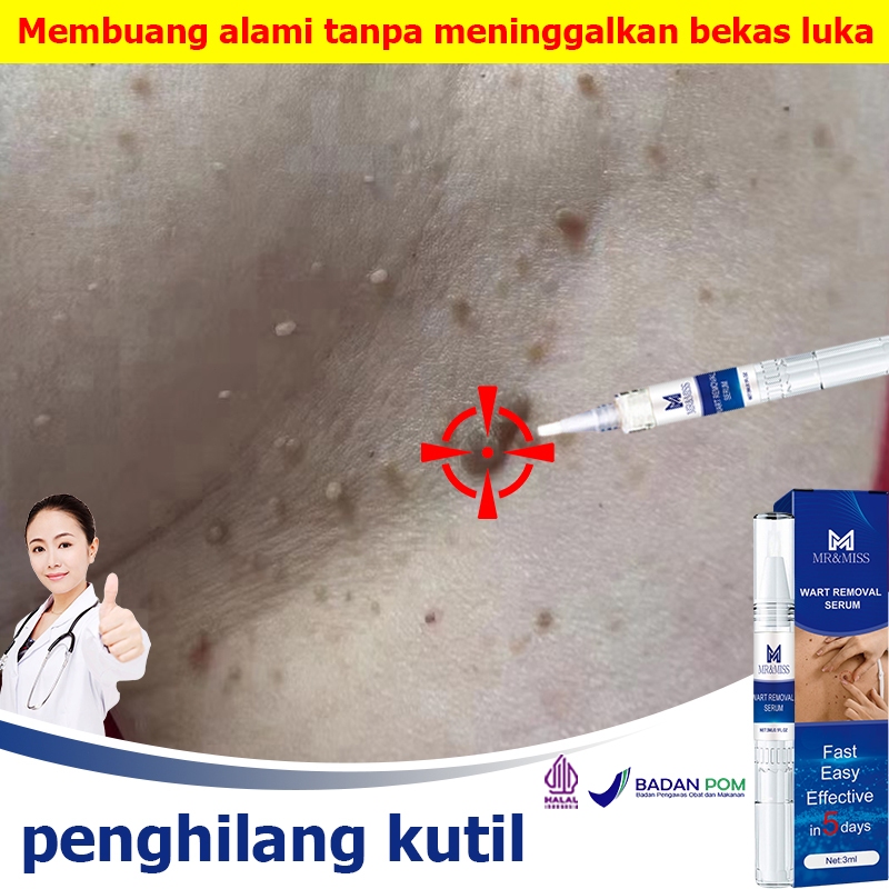 Penghilang kutil dan tahi lalat Penghilang tahi lalat di wajah Penghilang kutil Obat penghilang tahi