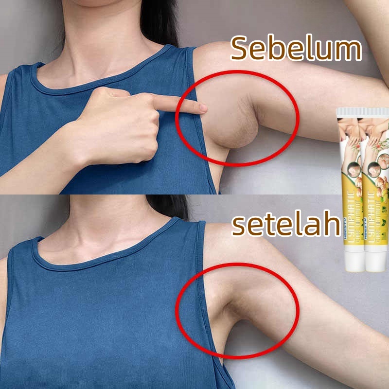 Obat Salep Cream Krim Untuk Penghilang Benjolan Kelenjar Getah Bening Lipoma lymph cream benjolan