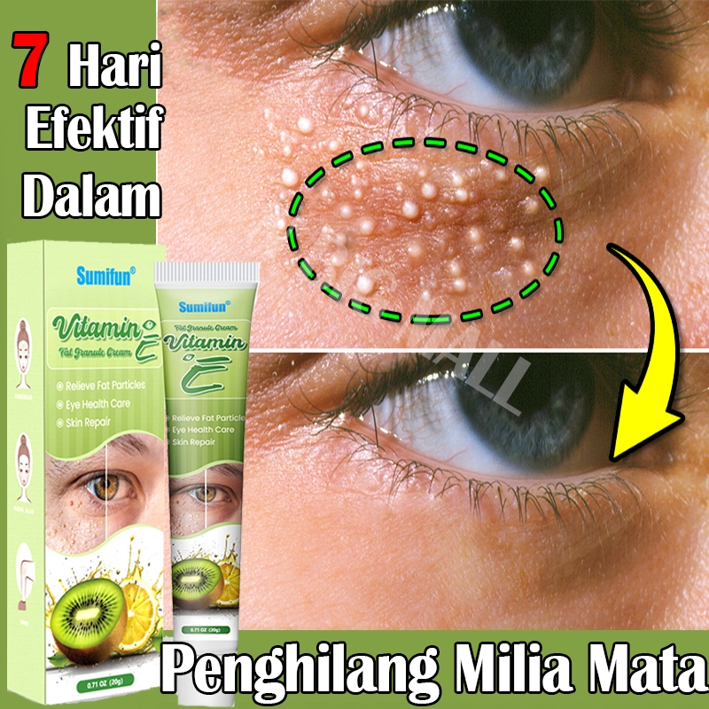 Krim penghilang milia Obat milia Salep Penghilang Milia Milia Cream Milia remover di bawah mata Mili