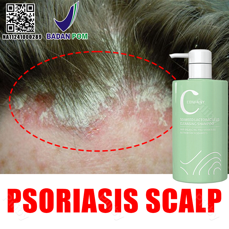 shampoo anti ketombe dan gatal Penghilang ketombe berkerak dan gatal psoriasis shampoo penghilang ke