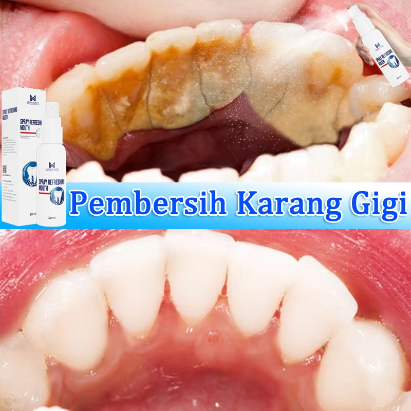 Penghilang karang gigi perontok karang gigi paling ampuh pembersih karang gigi 30ml penghilang karan
