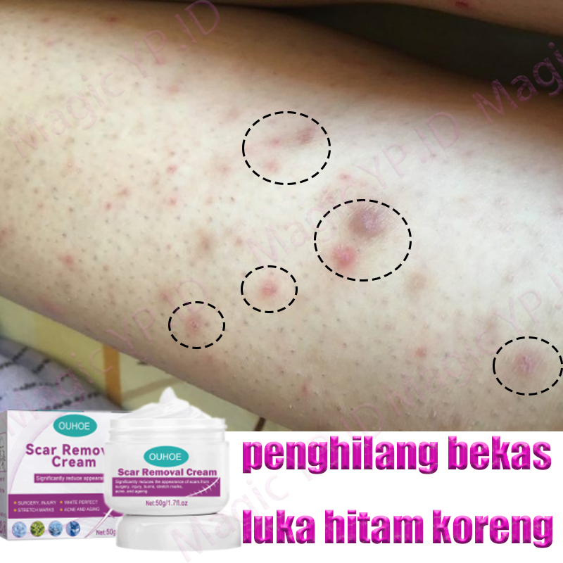 penghilang bekas luka hitam koreng penghilang bekas luka obat keloid penghilang bekas luka bakar pen