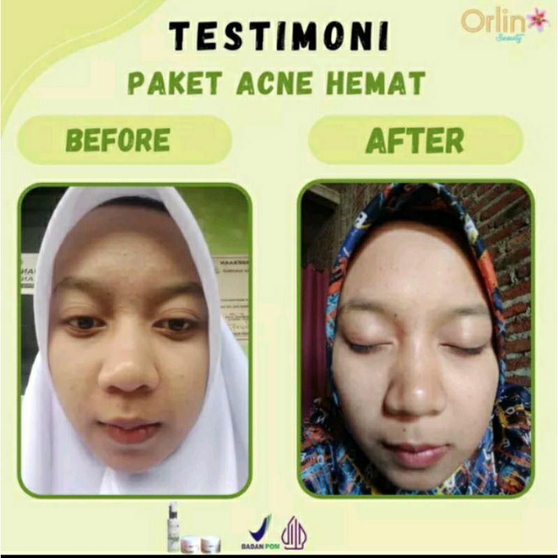 Serum acne orlin beauty/orlin beauty skincare/orlin beauty