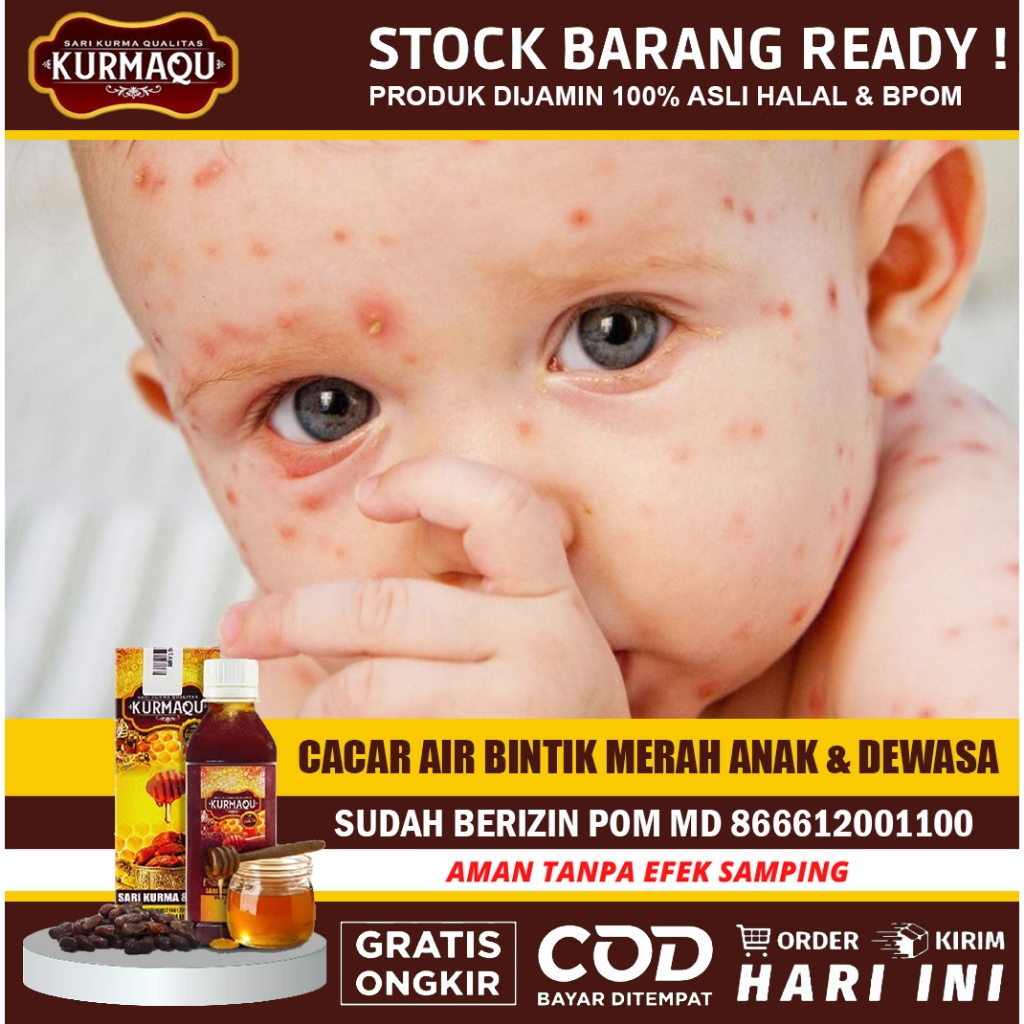 Obat Cacar, Obat Cacar Anak, Obat Cacar Bayi, Obat Cacar Air, Obat Cacar Api Aman Untuk  Anak Dan De
