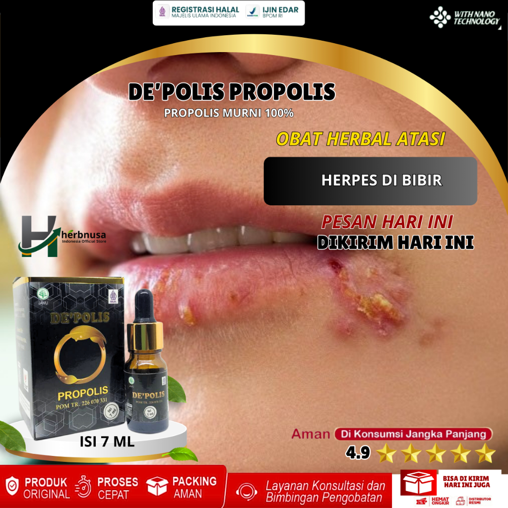 Obat Herpes Bibir, Bintik Bintik Putih Di Bibir, Luka Melepuh Sekitar Bibir, Bibir Bengkak, Bibir Ga
