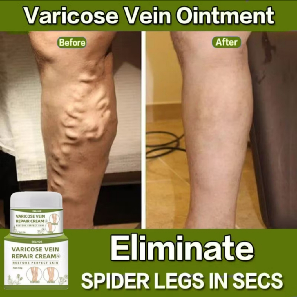 ORI SOUTH MOON VS EELHOE Krim Varises Semprotan Varises Mengurangi Varises Spray Pengobatan Varises