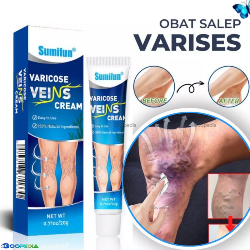 [ ORIGINAL 100% ] SUMIFUN VARICOSE SPIDER VEINS CREAM SALEP OBAT VARISES VENA VASKULITIS KAKI PAHA B
