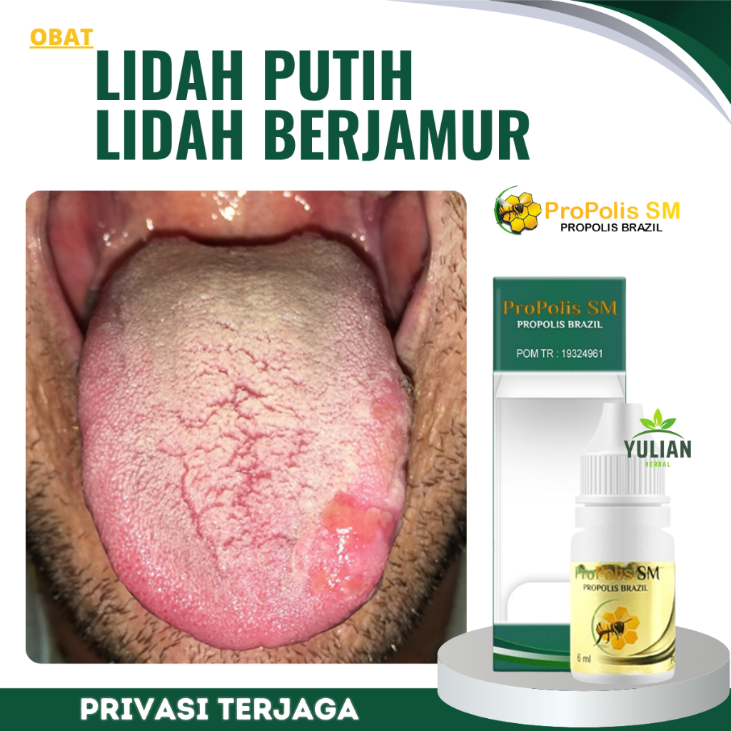 Obat Lidah Putih, Obat Lidah Berjamur, Obat Kandidiasis Mukokutan, Obat Pembersih Lidah Putih, Obat 