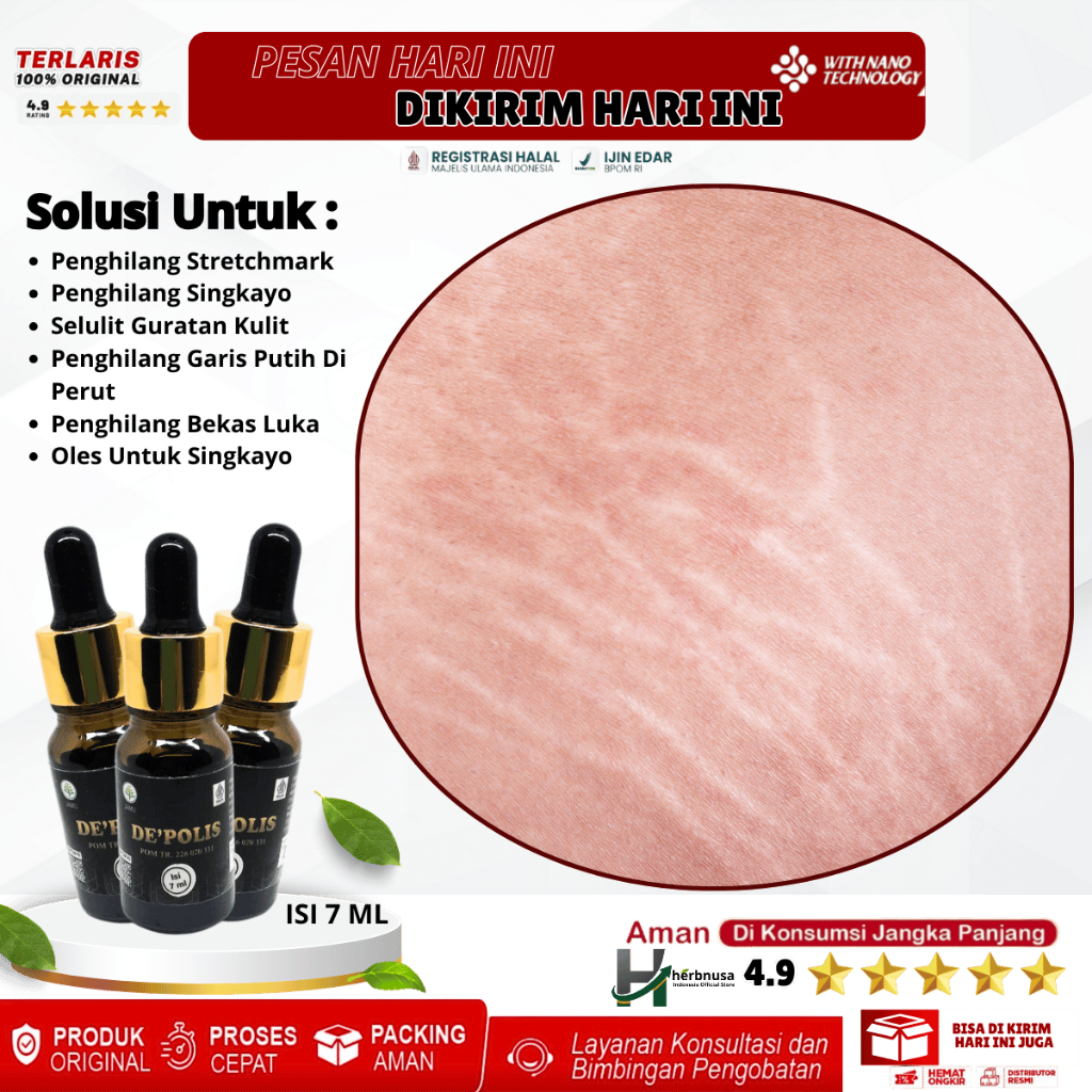 Obat Oles Penghilang Stretchmark, Penghilang Singkayo, Obat Penghilang Singkayo Di Perut, Paha, Pant