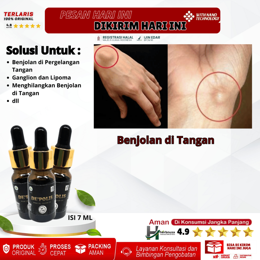 Obat Benjolan di Pergelangan Tangan, Obat Kista Ganglion, Obat Penghilang Benjolan di Tangan, Obat B