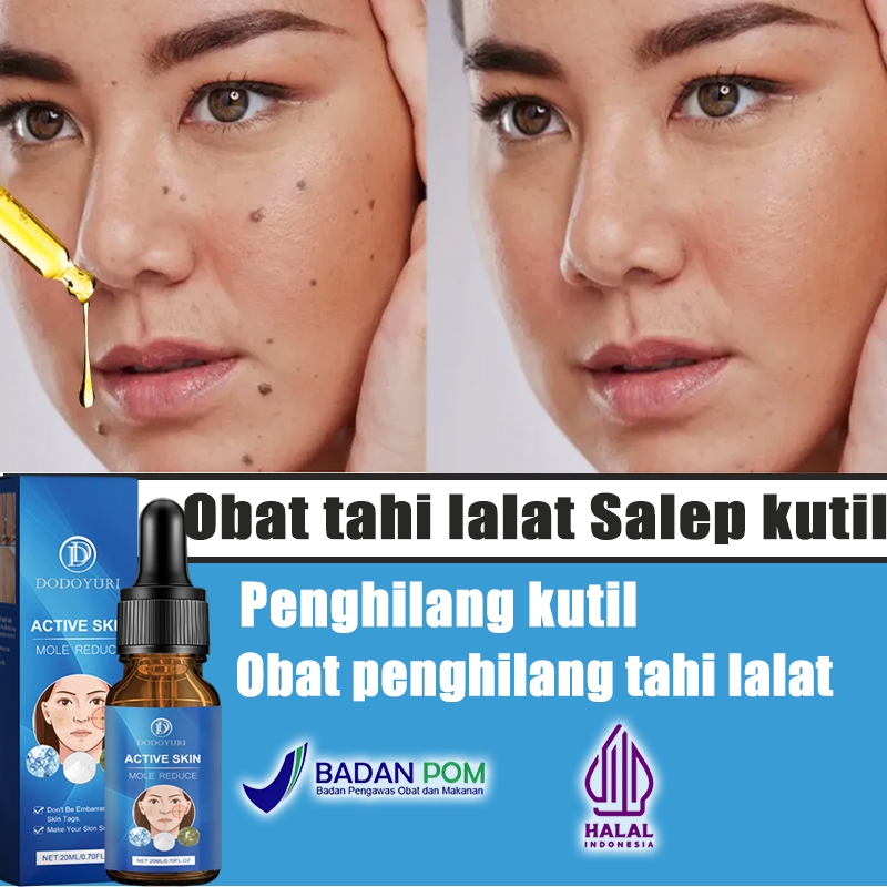 Obat penghilang tahi lalat Penghilang kutil dan tahi lalat Penghilang kutil Penghilang tahi lalat 1 