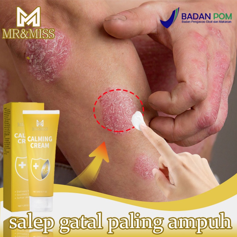 Obat gatal paling ampuh salep gatal paling ampuh obat gatal selangkangan 20ml salep gatal selangkang