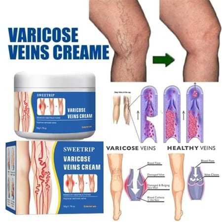 Cream Varises