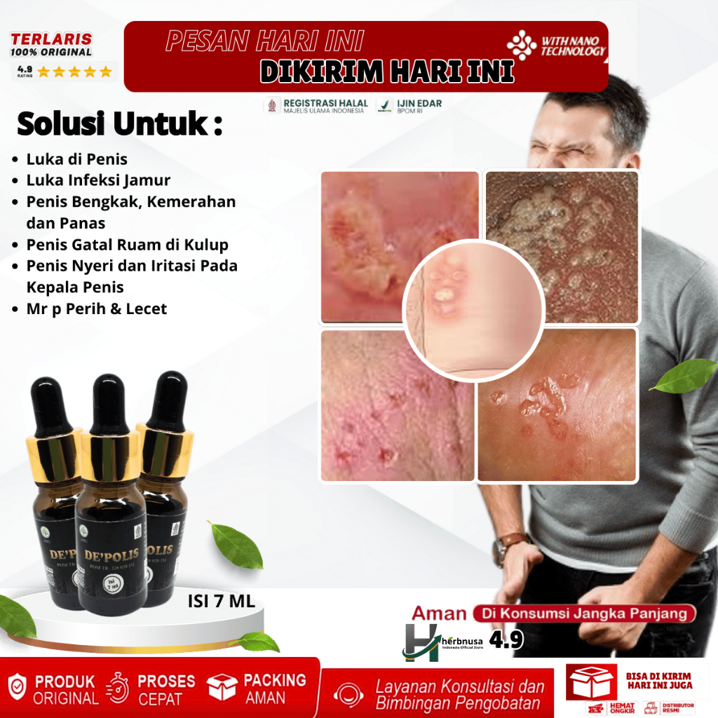 Obat Luka di Penis, Obat Luka Infeksi Jamur, Candida Albicans, Obat Penis Bengkak, Kemerahan dan Pan