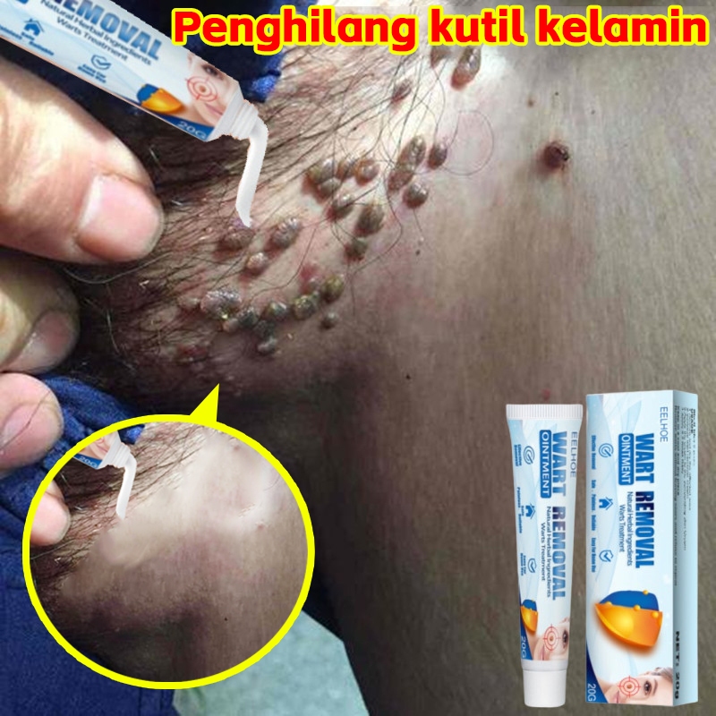 Penghilang kutil dan tahi lalat Obat penghilang kutil  Salep penghilang kutil Krim penghilang kutil 