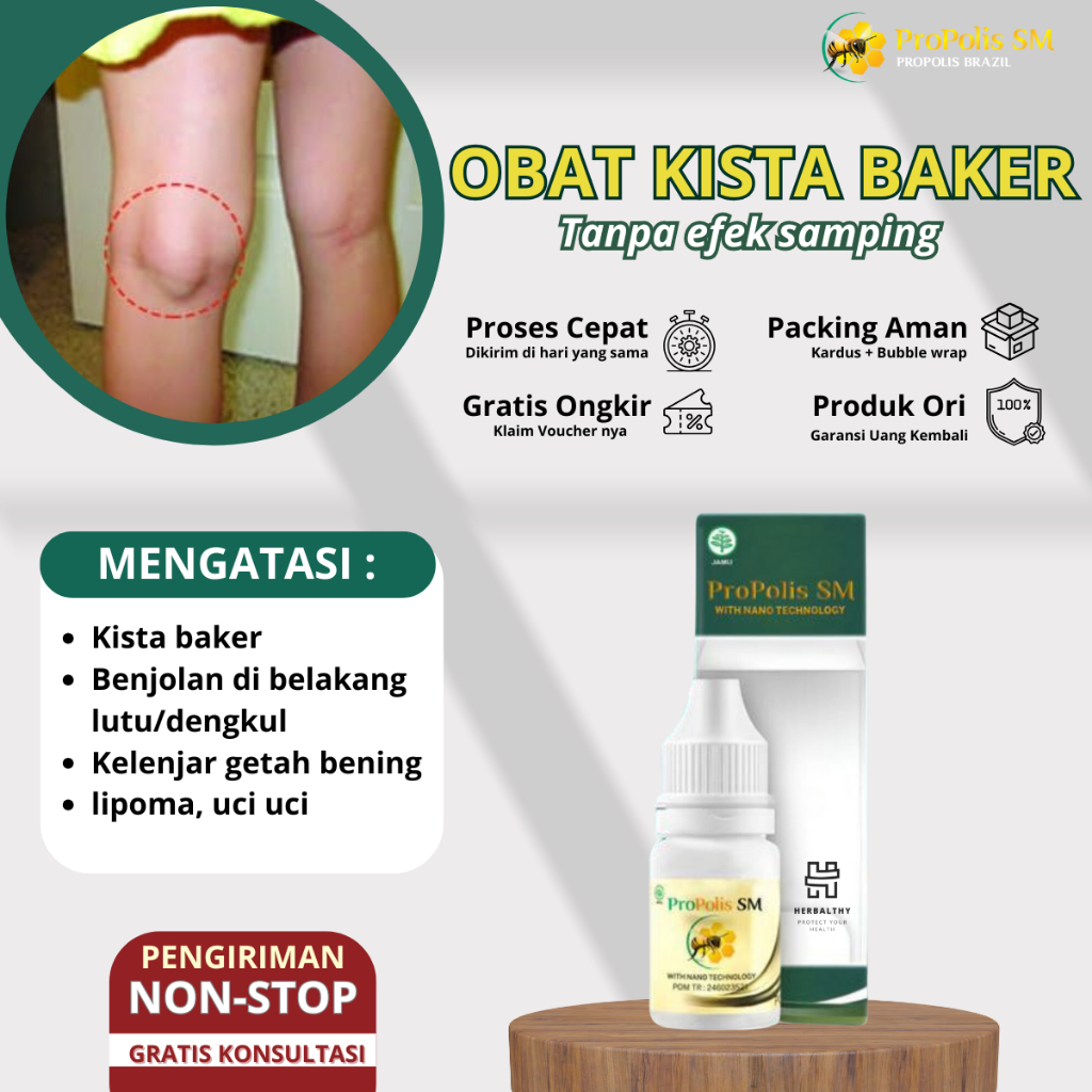 Obat Benjolan Lutut, Kista Baker Benjolan Belakang Lutut Obat Benjolan Di Belakang Lutut Kiri/Kanan 