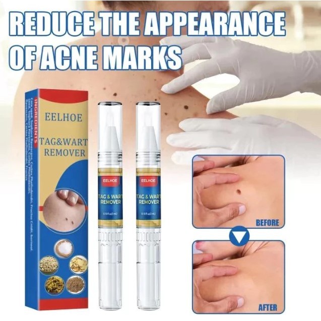 EELHOE Wart Remover Pen Cream - Krim Penghilang Tahi Lalat Kutil Tanpa Sakit