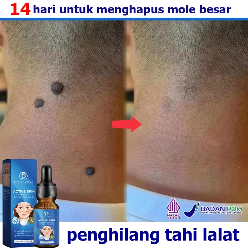 Penghilang tahi lalat Obat penghilang tahi lalat Obat tahi lalat 20ml Obat penghilang tai lalat Peng