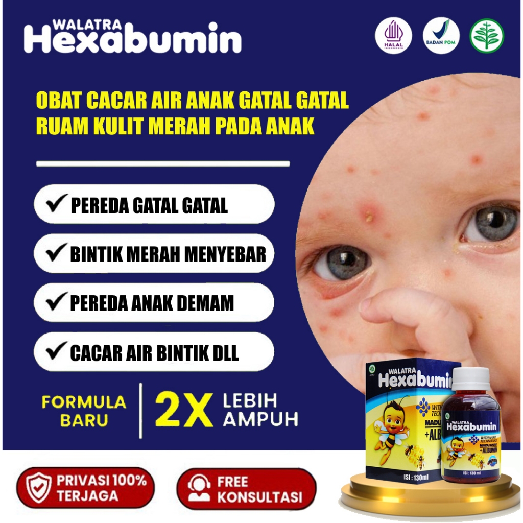 Obat Cacar Air Anak, Gatal Akibat Cacar Air, Cacar Air Untuk Balita, Mengobati   Ruam Kulit Merah Pa