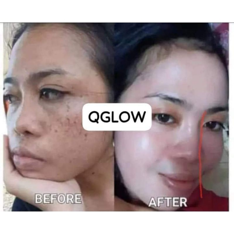 Q-glow Whitening