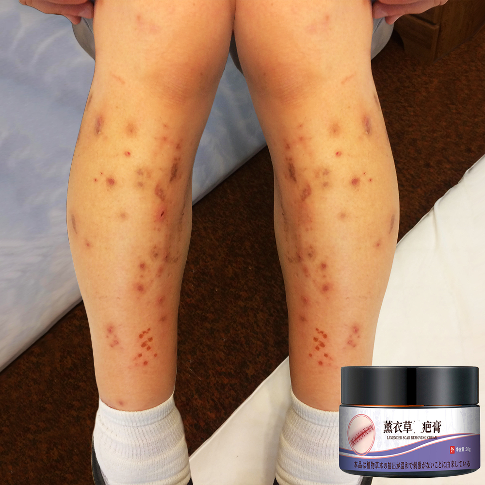 penghilang bekas luka hitam koreng salep penghilang bekas luka hitam penghilang bekas koreng penghil