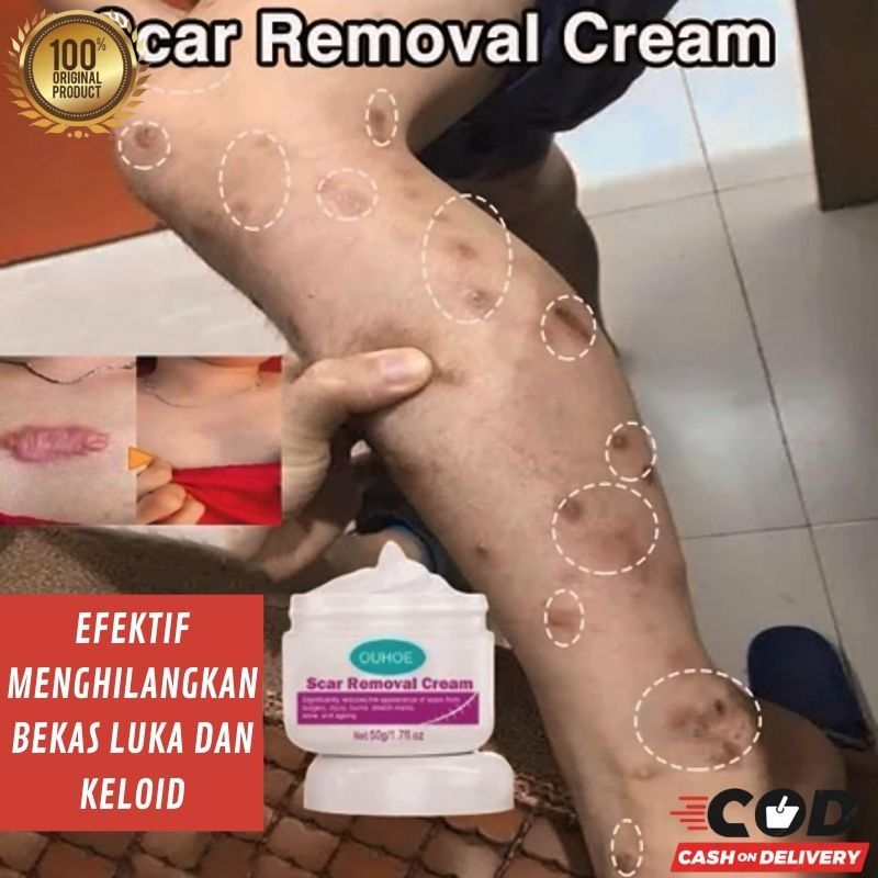Krim penghilang bekas luka koreng bintik hitam bekas gigitan nyamuk