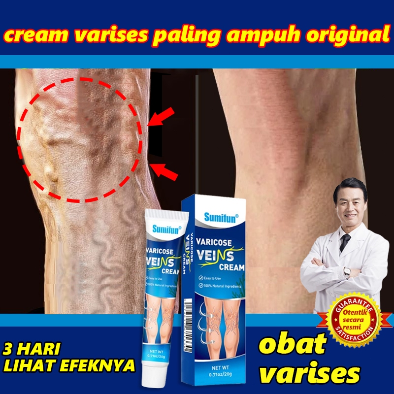 obat varises veins cream varises paling ampuh original obat varises di kaki salep untuk varises