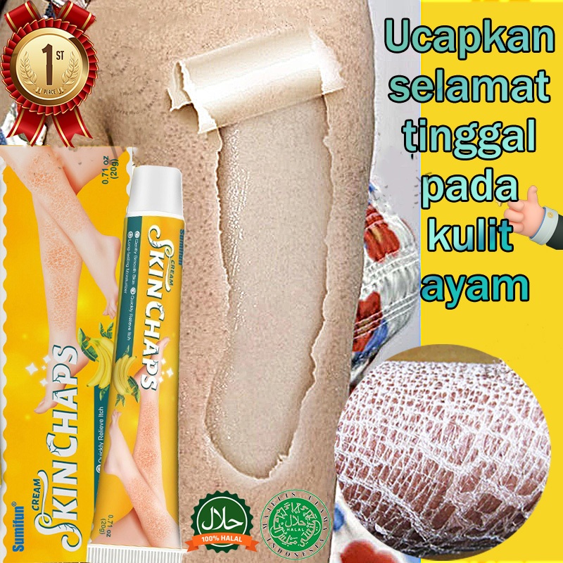 NEW Salep eksim Iktiosis Obat gatal kulit Salep ichthyosis kulit kering dan gatal Kulit kering dan