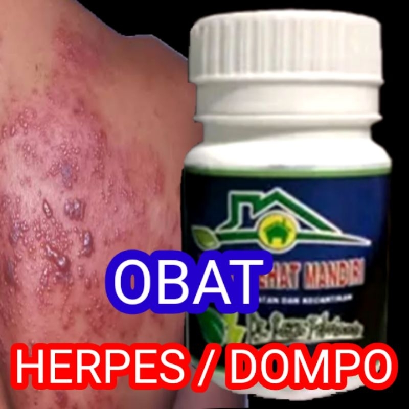 OBAT HERPES, DOMPO, CACAR AIR, CACAR Api dll