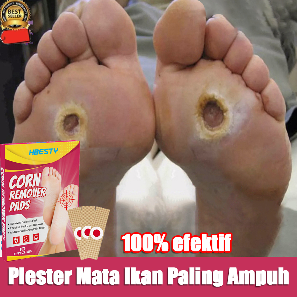 New Plester Mata Ikan Paling Ampuh Plester Kutil Dan Mata Ikan Obat Mata Ikan Telapak Kaki Obat Mata