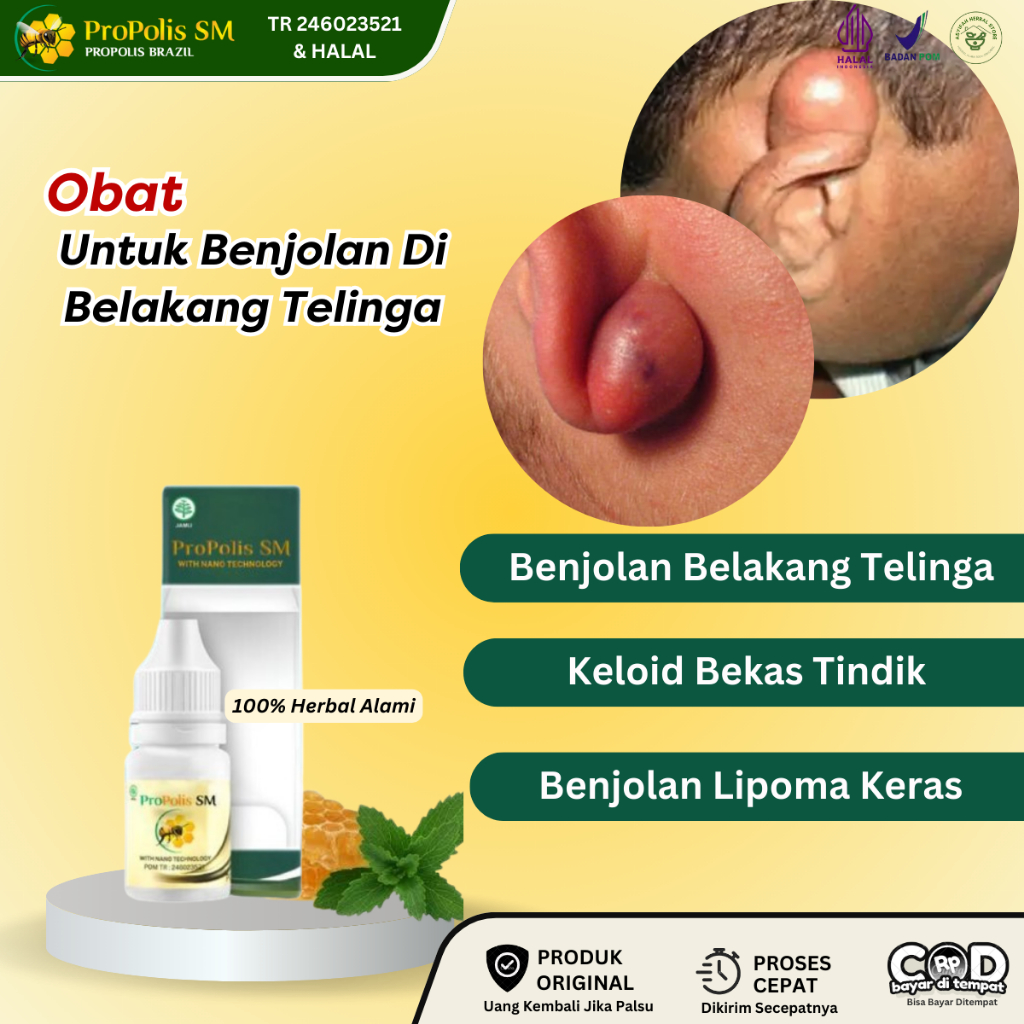 Obat Benjolan Di Belakang Telinga, Benjolan Di Daun Telinga, Obat Keloid Di Telinga Bekas Tindik, Be