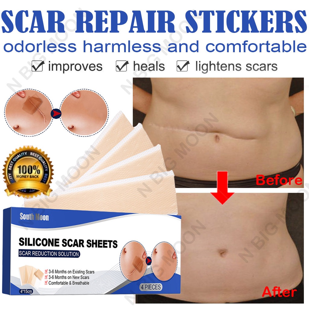 Silicone Scar Sheet plester silikon penghilang keloid bekas luka Silicon Keloid Plester Bekas Luka S