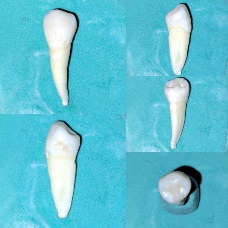 [GIGI ASLI] Premolar RB