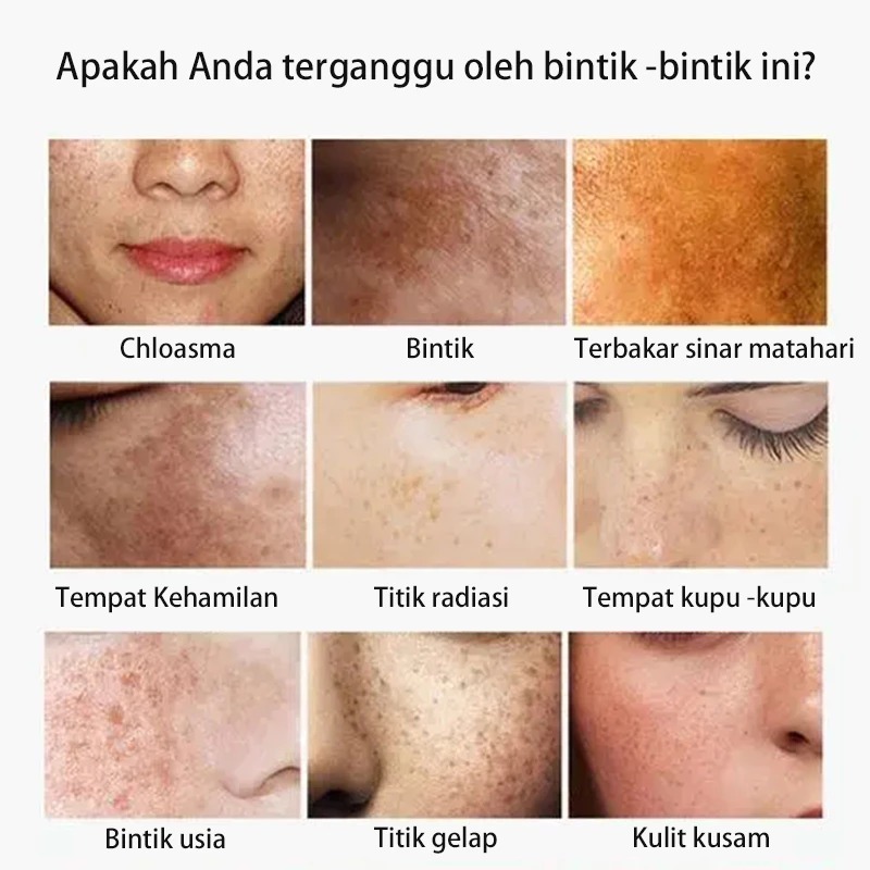 Cream Flek Hitam Melasma Membandel Krim Penghilang Flek Hitam 20g Cream Penghilang Flek Hitam