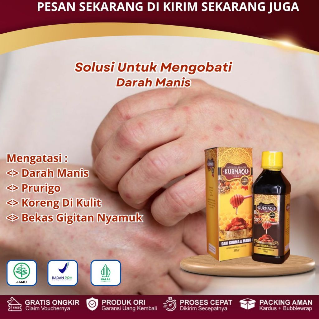 kurmaqu - Obat Darah Manis, Koreng Di Kaki, Gatal Akibat Gigitan Nyamuk, Prurigo, Ruam Kemerahan