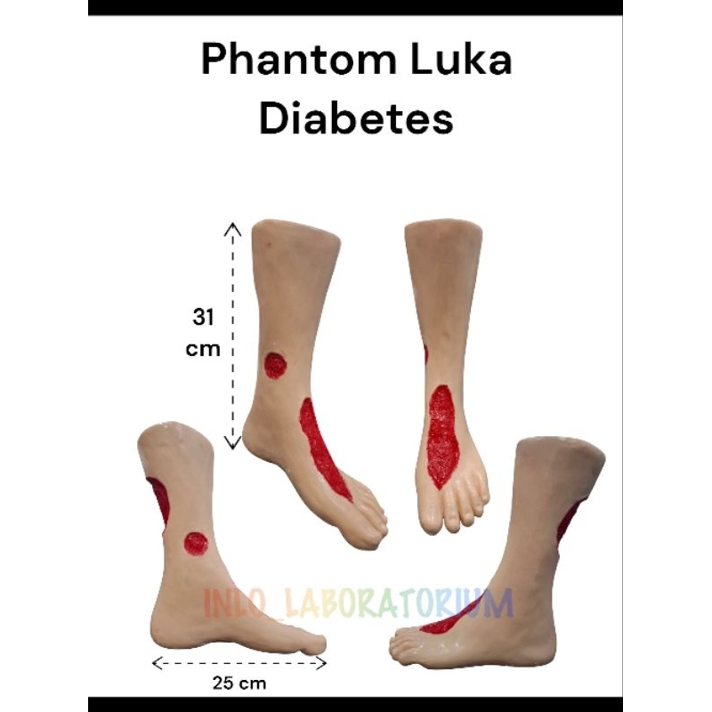 Phantom Luka Diabetes/Manekin Luka Diabetes/Model Luka Diabetes
