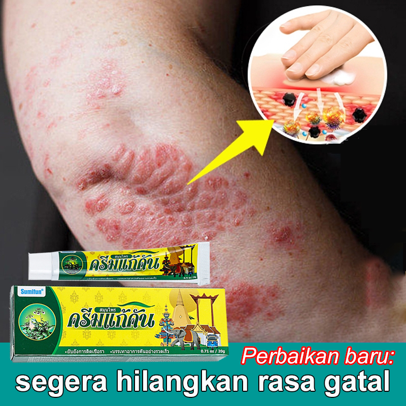 Salep Gatal Paling Ampuh Obat Gatal 20g Anti jamur Salep eksim Salep jamur Salep kulit Psoriasis Eks