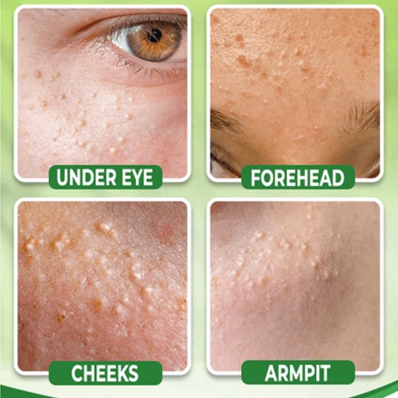 Krim Penghilang Milia Obat Milia Di Bawah Mata Cream Vitamin E Eye Cream Penghilang Milia Syringoma