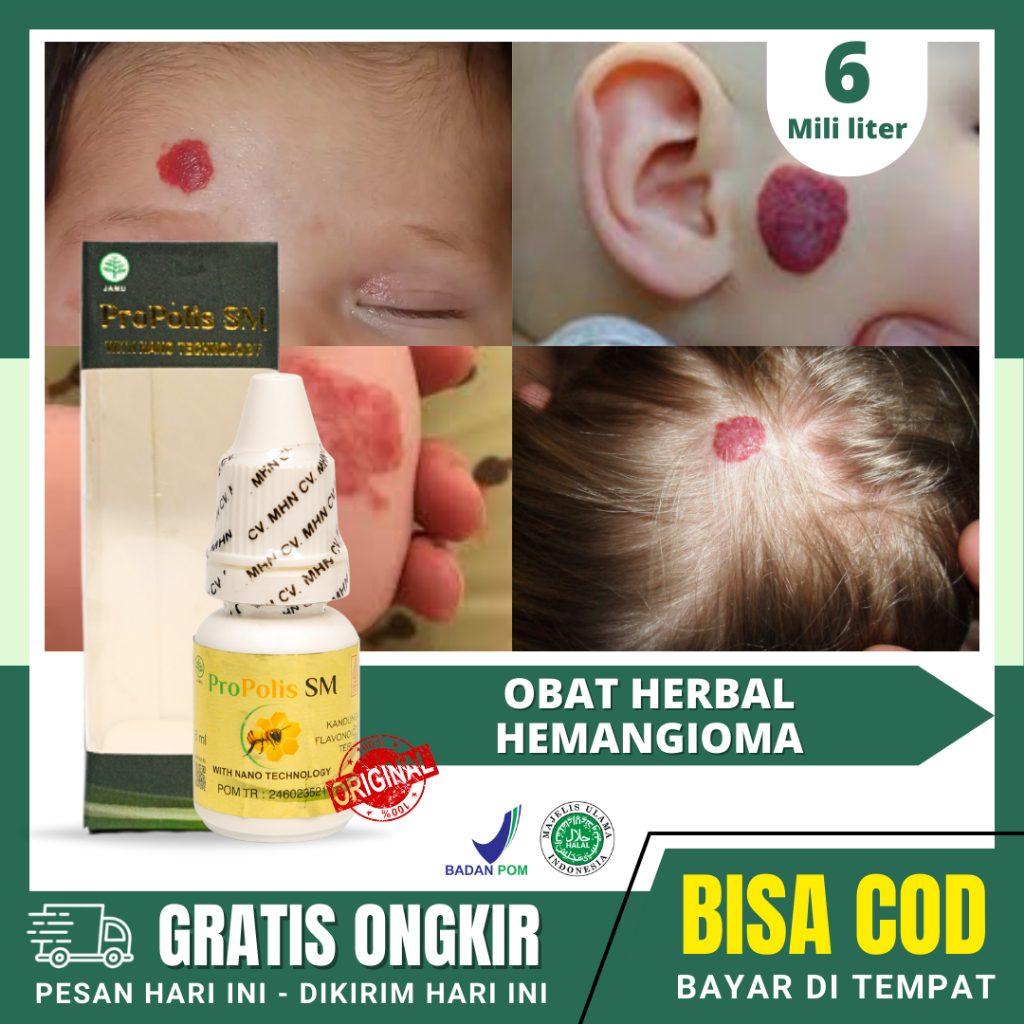 Obat Hemangioma Tumor Hemangioma Penghilang Tanda Lahir Merah PROPOLIS BRAZIL Bisa Untuk Semua Usia