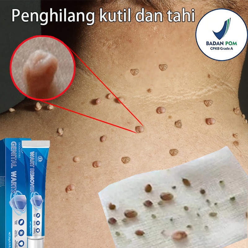 Obat kutil Penghilang kutil dan tahi lalat Obat kutil kelamin 20ml Menghilangkan kutil tahi lalat be