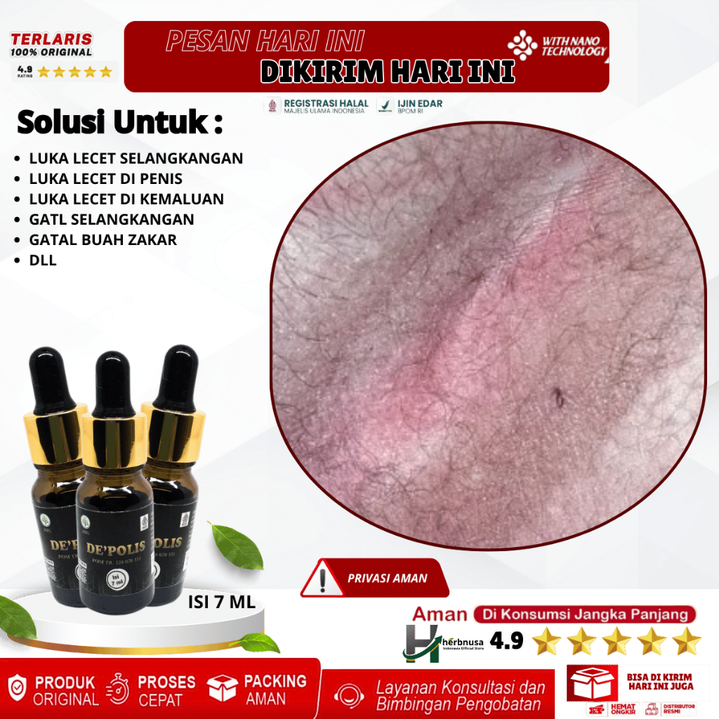 Obat Luka Lecet Selangkangan Luka Lecet di Penis Luka Lecet di Kemaluan Gatal Buah Zakar Pria Penger