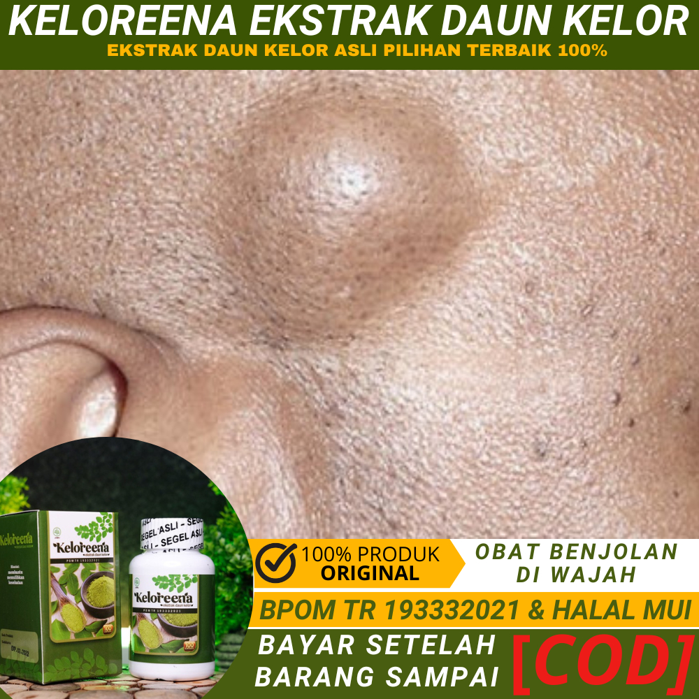 Obat Benjolan Di Wajah, Muka, Pipi, Dahi, Di Bawah Mata, Obat Pengempis Benjolan Lipoma, menghilangk