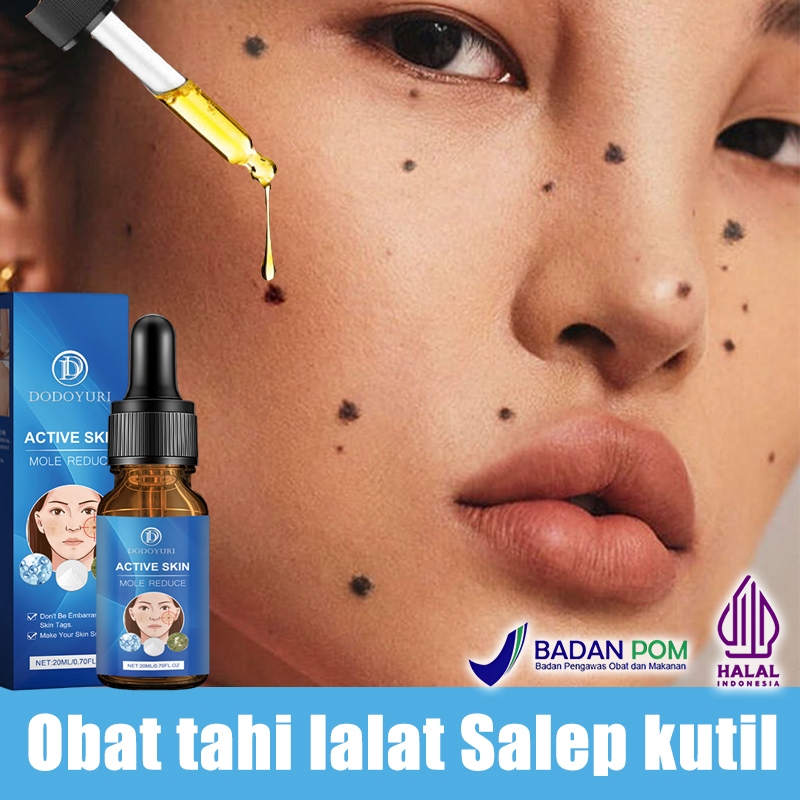Obat penghilang tahi lalat Penghilang tahi lalat di wajah Penghilang kutil 20ml penghilang kutil dan