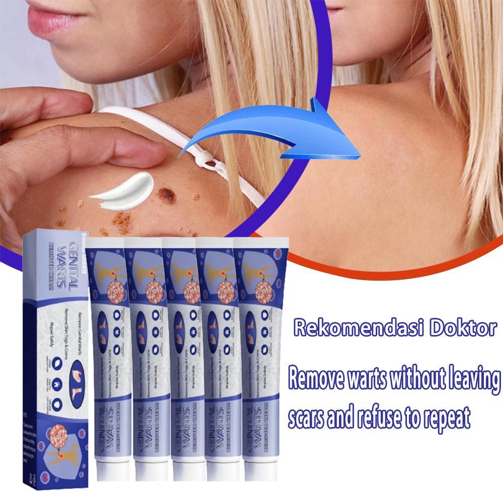 Obat Kutil paling ampuh wart remover skin tag cream penghilang kutil papiloma di wajah obat kutil al