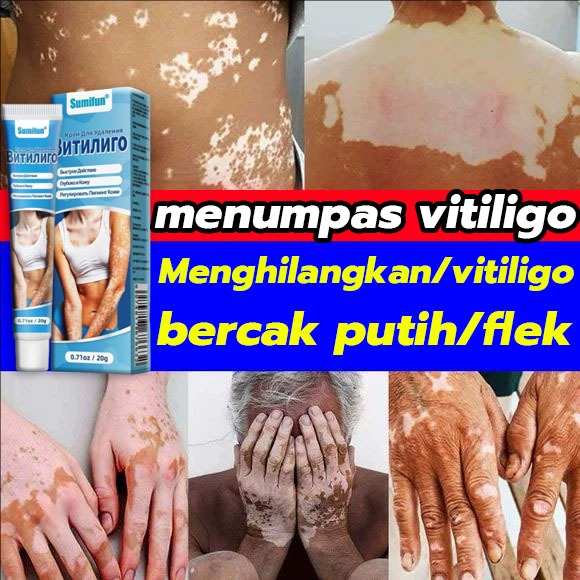 obat kulit vitiligo Vitiligo Kulit Bercak Putih Belang Menghilangkan Vitiligo di Tangan Kaki Wajah M