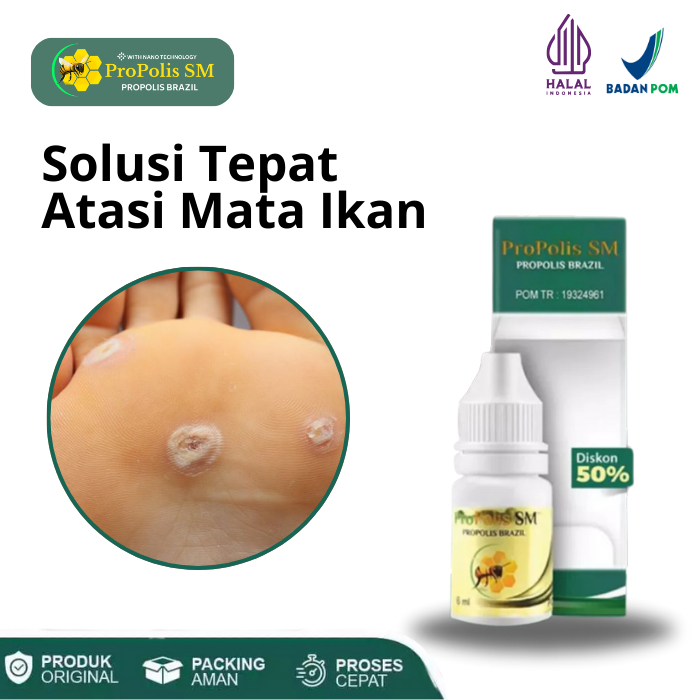 Obat Penghilang Mata Ikan Ditelapak Kaki Dan Tangan Herbal Untuk Anak Dan Dewasa Propolis SM